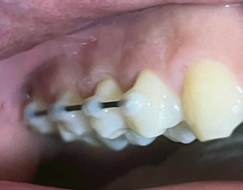 임플란트-반대편-치아-고정