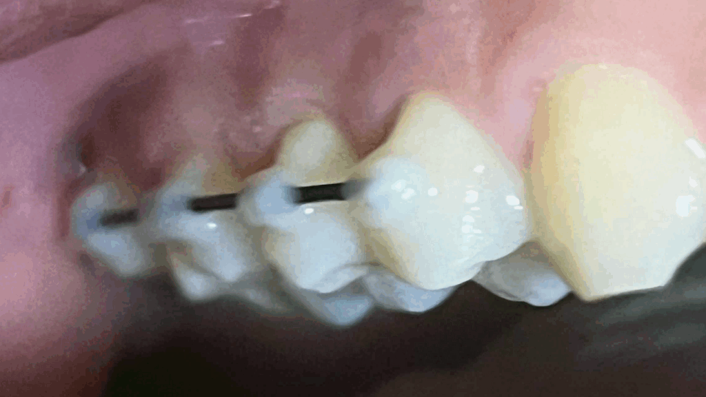 임플란트-전-치아사진