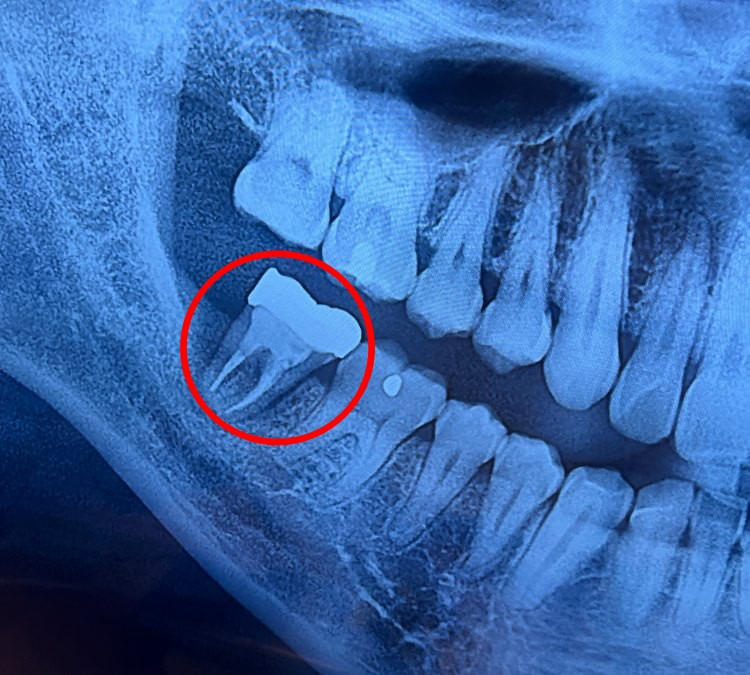 임플란트-하기전-치아-상태